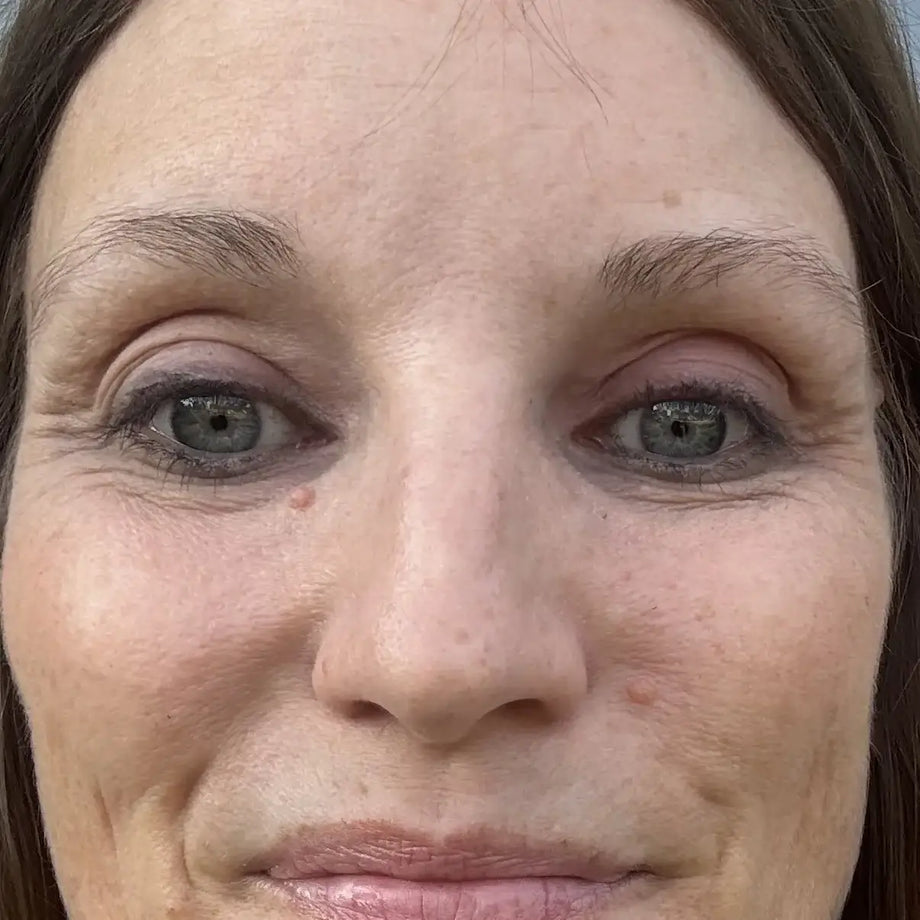 Kate before and after using GLARISE eyelid strips