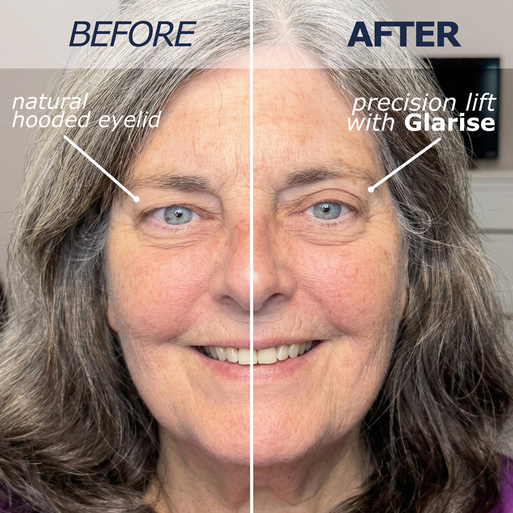 Customer before and after comparison showing a hooded eyelid and the lifted appearance with GLARISE