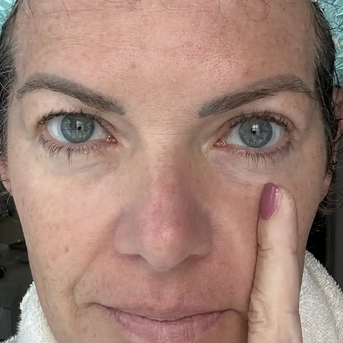 Original GLARISE customer eyelid result