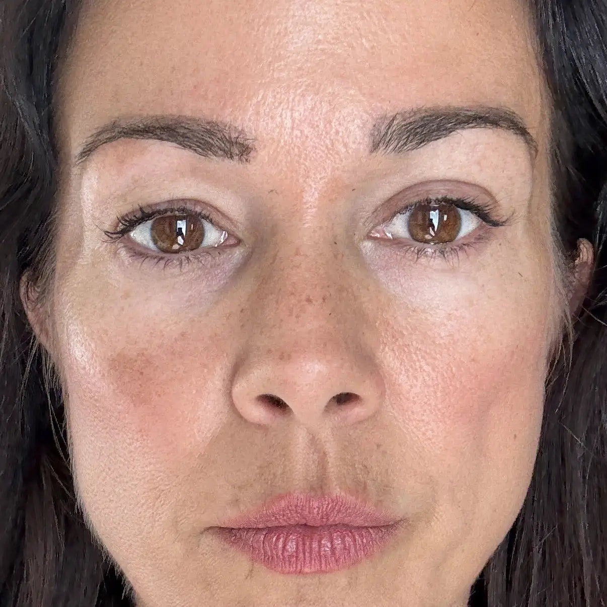 Original GLARISE customer eyelid result