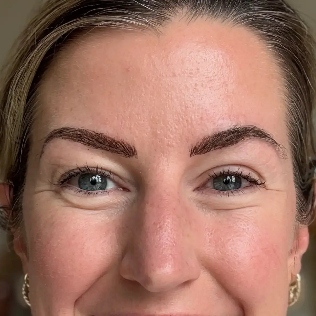 Original GLARISE customer eyelid result