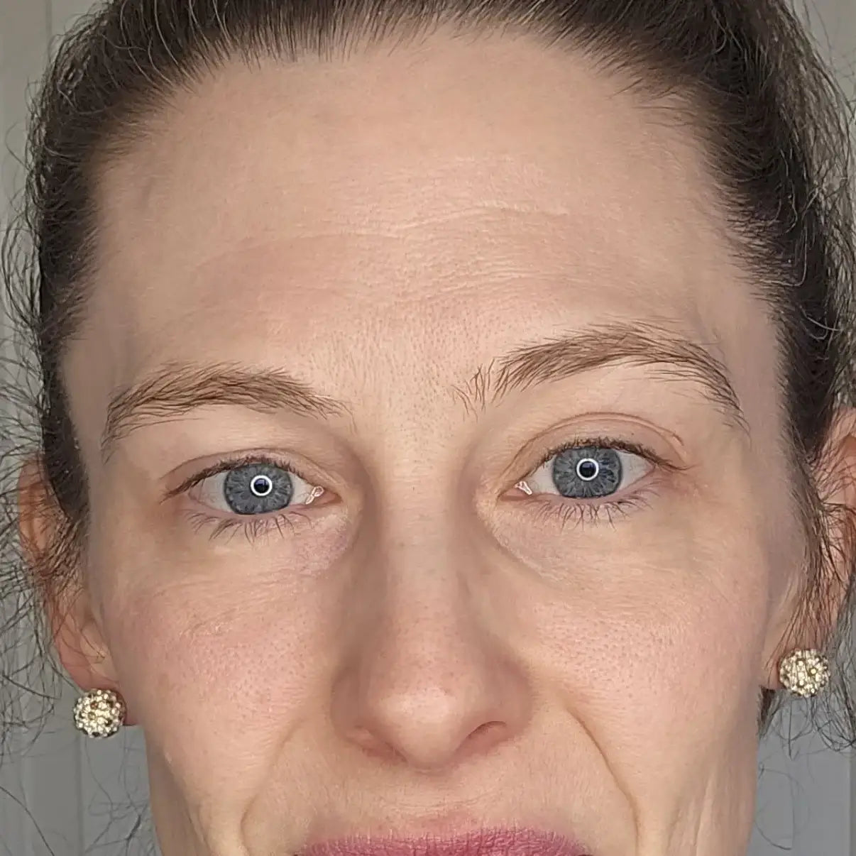 Original GLARISE customer eyelid result